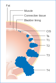 https://upload.wikimedia.org/wikipedia/commons/thumb/5/5c/Diagram_showing_the_T_stages_of_bladder_cancer_CRUK_372.svg/220px-Diagram_showing_the_T_stages_of_bladder_cancer_CRUK_372.svg.png