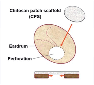 Chitosan patch scaffold(CPS), Eardrum, Perforation