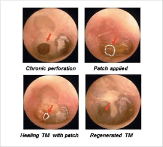 Chronic perforation, Patch applied, Healing TM with patch, Regenerated TM